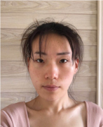北京京韓張振脂肪填充怎么樣？附填充案例分享+2021價(jià)格表曝光
