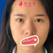 濟南伊美爾整形醫(yī)院鼻綜合案例，改變不止一點點