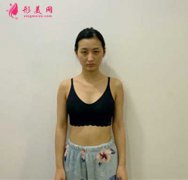 分享我去廣州曙光整形美容醫(yī)院做假體隆胸手術(shù)