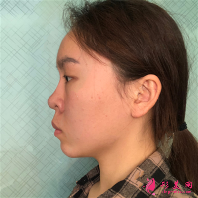 成都小姐姐的鼻綜合手術(shù)術(shù)后效果分享圖