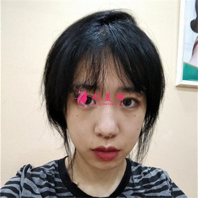 重慶埋線雙眼皮術(shù)后恢復(fù)效果對(duì)比