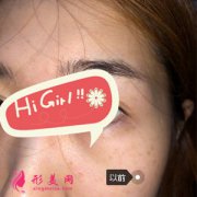 濟(jì)寧韓美整形醫(yī)院激光祛斑半年后效果圖