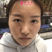 杭州同榮麗格醫(yī)療美容肋軟骨隆鼻術(shù)后恢復(fù)情況對(duì)比