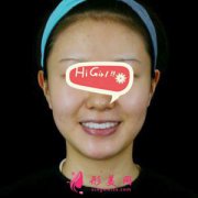 廣州廣大整形美容醫(yī)院熱瑪吉除皺真人案例 有點(diǎn)貴 但效果很值得