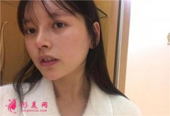 深圳富華醫(yī)療美容醫(yī)院光子嫩膚術(shù)后恢復(fù)效果對(duì)比圖分享