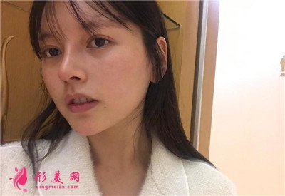 南寧光子嫩膚術(shù)后恢復(fù)效果對(duì)比圖分享