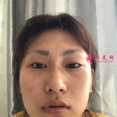 武漢全切雙眼皮術(shù)后恢復(fù)效果展示