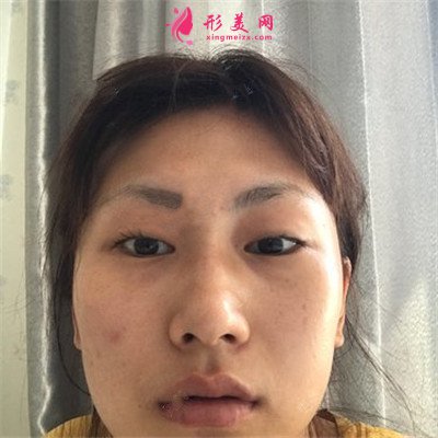 武漢全切雙眼皮術后恢復效果展示