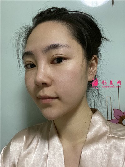 重慶小姐姐膨體隆鼻術(shù)后恢復(fù)情況對比