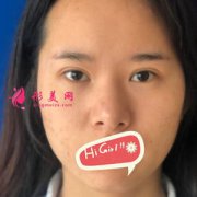 濟南伊美爾整形醫(yī)院鼻綜合案例 改變不止一點點