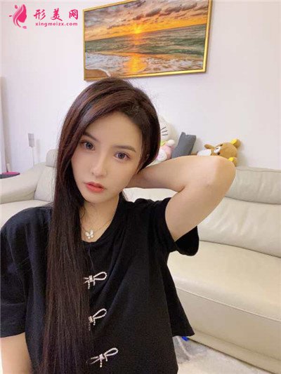 深圳定點雙眼皮術后恢復效果分享 術后 深圳定點雙眼皮術后恢復效果分享