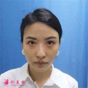 深圳富華醫(yī)療美容醫(yī)院雙眼皮術(shù)后恢復(fù)效果分享