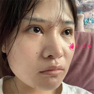 北京小仙女的硅膠假體隆鼻術(shù)后效果反饋