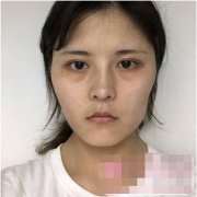 成都美容整形醫(yī)院（成美）      我本身的臉很凹，臉頰又不豐滿一
