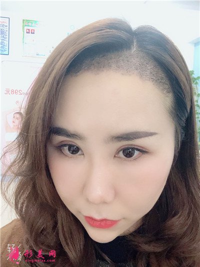 成都植發(fā)際線1700單位術(shù)后效果對(duì)比圖分享 術(shù)后 成都植發(fā)際線1700單位術(shù)后效果對(duì)比圖分享