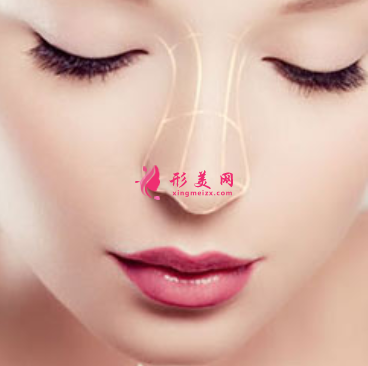 假體隆鼻費(fèi)用大概是多少