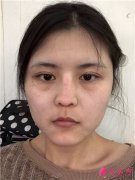 北京煤炭總醫(yī)院膨體隆鼻手術術后恢復效果對比