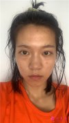 北京彤美醫(yī)療美容醫(yī)院眼綜合術后案例反饋