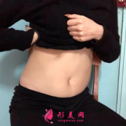 北京藝美整形腰腹吸脂真人案例 小蠻腰立顯
