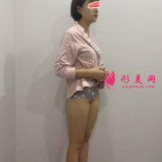 大腿吸脂效果好嗎?廣州紫馨整形醫(yī)院真實效果反饋