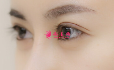 切開雙眼皮的術(shù)后護(hù)理要怎么做