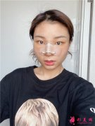 廣州廣大整形美容醫(yī)院肋軟骨隆鼻術后恢復情況對比
