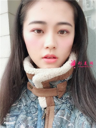 武漢全切雙眼皮術(shù)后恢復(fù)效果展示分享 術(shù)后 武漢全切雙眼皮術(shù)后恢復(fù)效果展示分享