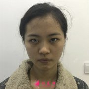 武漢藝星醫(yī)療美容醫(yī)院全切雙眼皮術后恢復效果展示分享