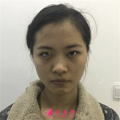 武漢全切雙眼皮術(shù)后恢復(fù)效果展示分享