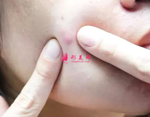 激光祛痘印要做幾次