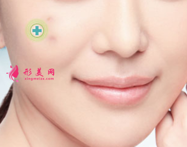 激光祛痘印什么時候看到效果