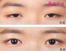 眼瞼下垂的種類有哪些？矯正方法及注意事項(xiàng)分享