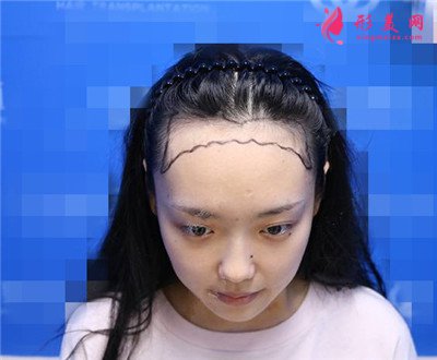杭州發(fā)際線種植術(shù)后恢復(fù)情況對(duì)比
