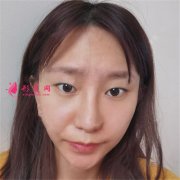 廣州華美醫(yī)療美容醫(yī)院定點雙眼皮術(shù)后效果展示