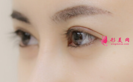 埋線雙眼皮會(huì)有風(fēng)險(xiǎn)嗎