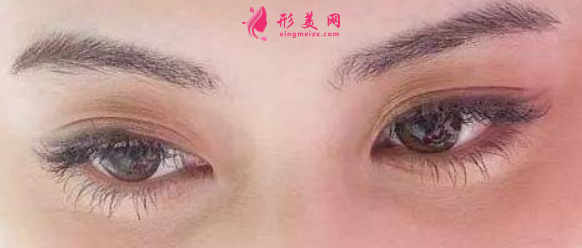 埋線雙眼皮后什么時(shí)候可以化妝