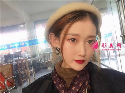 武漢小仙女全切雙眼皮術(shù)后恢復(fù)情況反饋