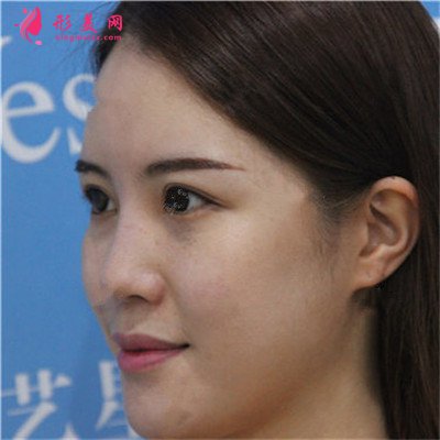 濟(jì)南鼻綜合手術(shù)術(shù)后恢復(fù)情況對(duì)比