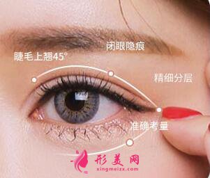 埋線雙眼皮價(jià)格大約是多少