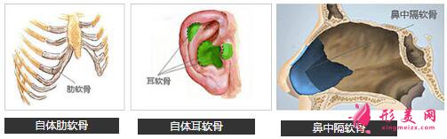 自體軟骨隆鼻后有沒有后遺癥