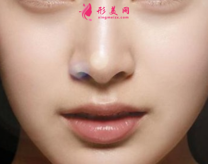 自體軟骨隆鼻大概費(fèi)用是多少