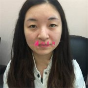 廣州廣大整形美容醫(yī)院全切雙眼皮術(shù)后恢復(fù)情況對比