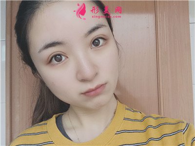 廣州全切雙眼皮術(shù)后恢復(fù)情況對(duì)比 術(shù)后 廣州全切雙眼皮術(shù)后恢復(fù)情況對(duì)比