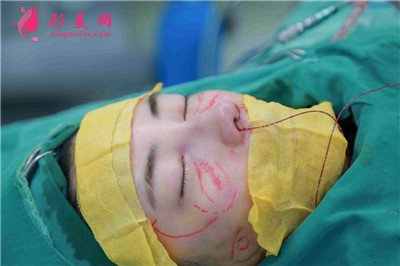 鄭州鼻綜合術(shù)后恢復(fù)效果對比圖反饋