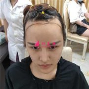 成都恒博植發(fā)發(fā)際線移植手術(shù)術(shù)后效果反饋