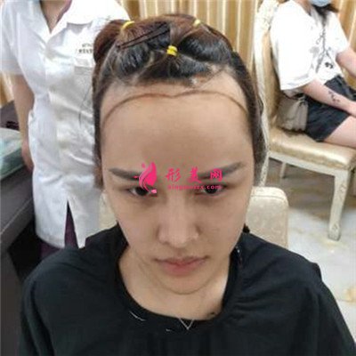 廈門發(fā)際線移植手術術后效果反饋