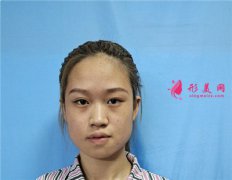 長沙亞韓美容整形醫(yī)院小姐姐吸脂瘦臉術(shù)后效果反饋