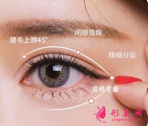 雙眼皮手術(shù)有哪些常見的風(fēng)險(xiǎn)