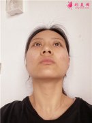 深圳富華醫(yī)療美容醫(yī)院眼綜合手術術后恢復情況對比？