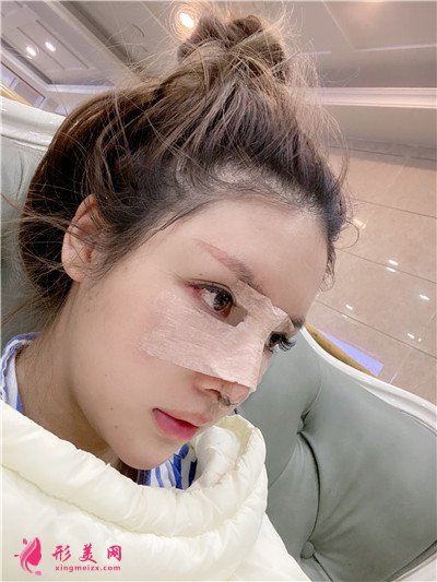 重慶耳軟骨隆鼻術(shù)后恢復(fù)效果分享
